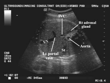 Check spelling or type a new query. Abdominal Circumference