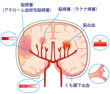 最も検索 脳 梗塞 イラスト 興味深い画像の多様性