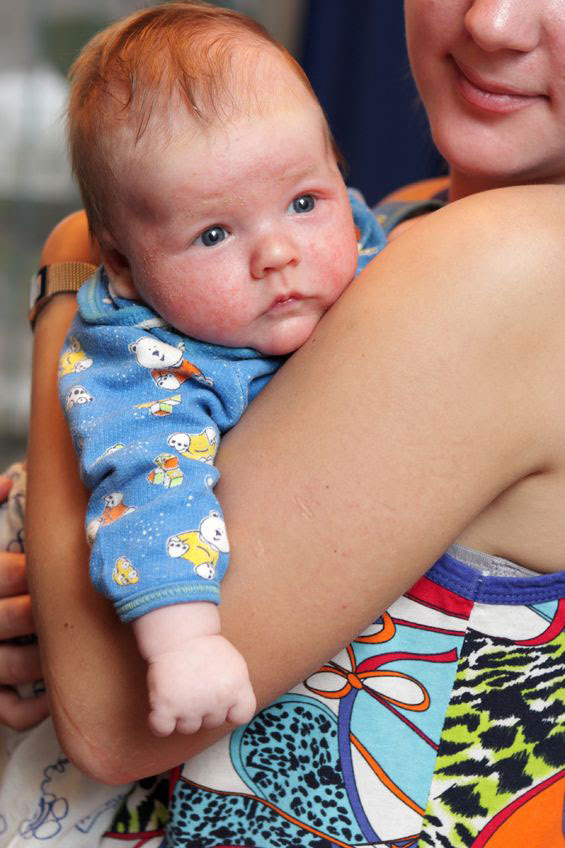 How To Know If My Baby Has A Milk Allergy - Baby Viewer