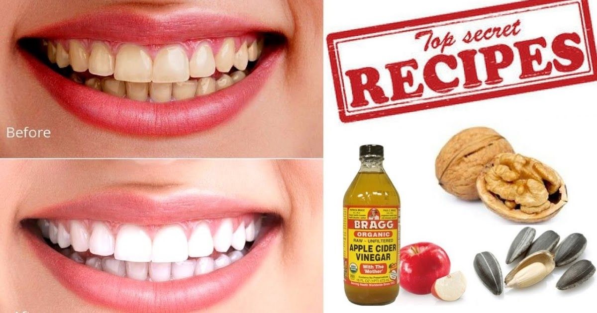 Apple Cider Vinegar And Plaque On Teeth - Teeth Poster
