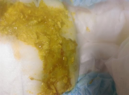 Porque Mi Bebe Hace Popo Con Moco Y Sangre Consejos De Bebe