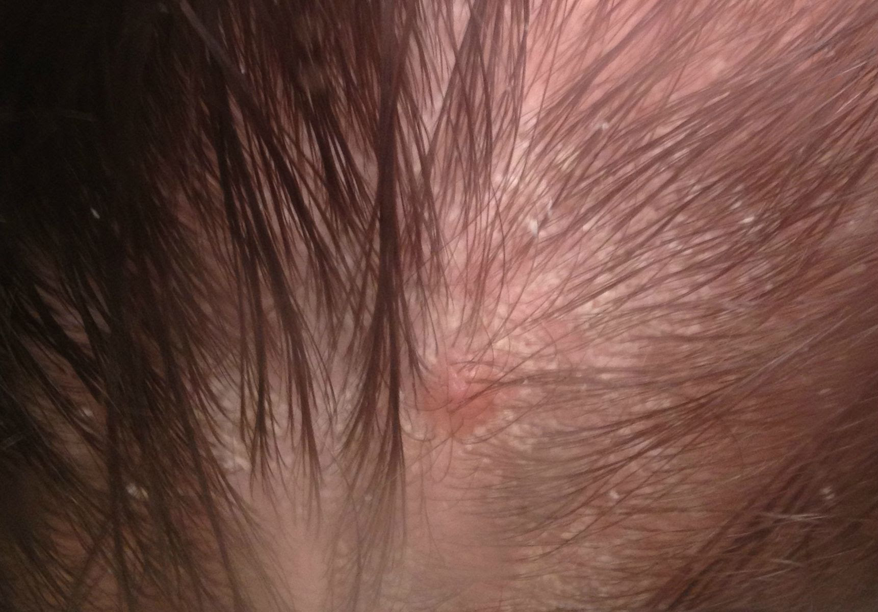 The term 'eczema' is used for a group of conditions that show a similar pattern of changes in the skin, giving rise to specific changes on the surface. Best Seborrhoeic Dermatitis Treatment For Scalp Cost In Mumbai India Qr678
