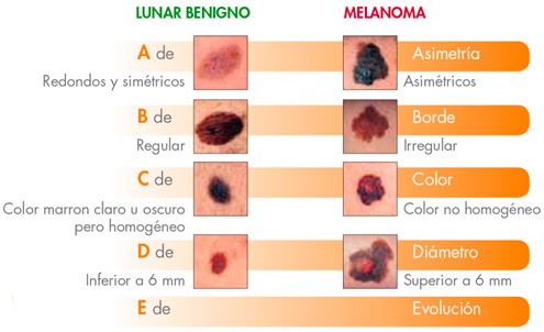 La causa más común del melanoma es la exposición a radiación ultravioleta (uv) proveniente de los. Sabes Cuando Sospechar Un Cancer De Piel Signos Y Sintomas Para La Deteccion Precoz Del Cancer De Piel Tipo Melanoma Y No Melanoma 13 Junio Dia Munial Cancer De Piel