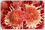 Study reveals how aggressive prostate cancer metastasizes by evading the immune system