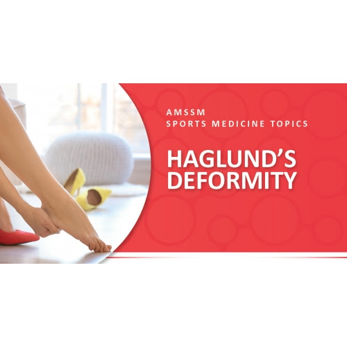 As associated problems such as heel bursitis settle, the size of the lump should reduce, but the bony lump of haglunds deformity may never completely go without. Haglund S Deformity Sports Medicine Today