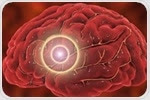 NIH trial aims to improve drug discovery for ischemic stroke