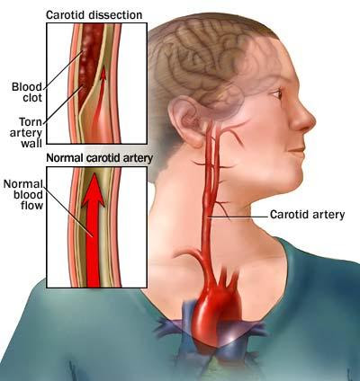 Thrombotic Stroke Definition