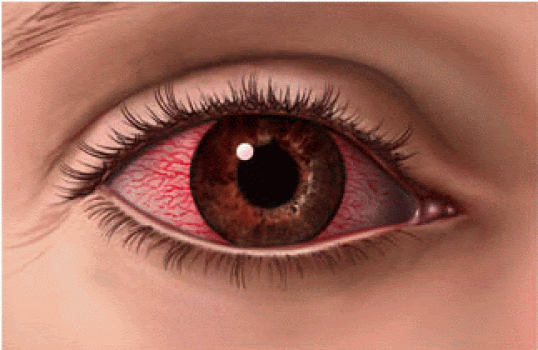 Dulu dianggap sebagai pejuang kesetaraan dan keberagaman, sekarang berkarib dengan para pecundang intoleran. Prevencion De La Conjuntivitis Farmacia Seccion Optica Vazquez