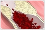 New nanoparticle innovation detects vascular calcification in atherosclerosis