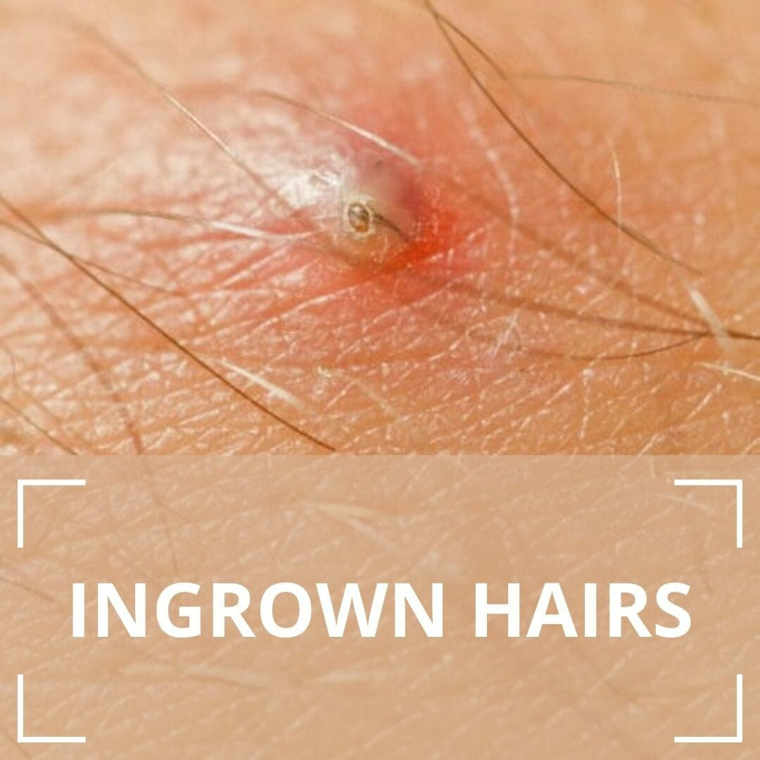 An ingrown hair is what happens when a hair curls back and grows into the skin. Ingrown Hairs Folliculitis London Premier Laser Clinic
