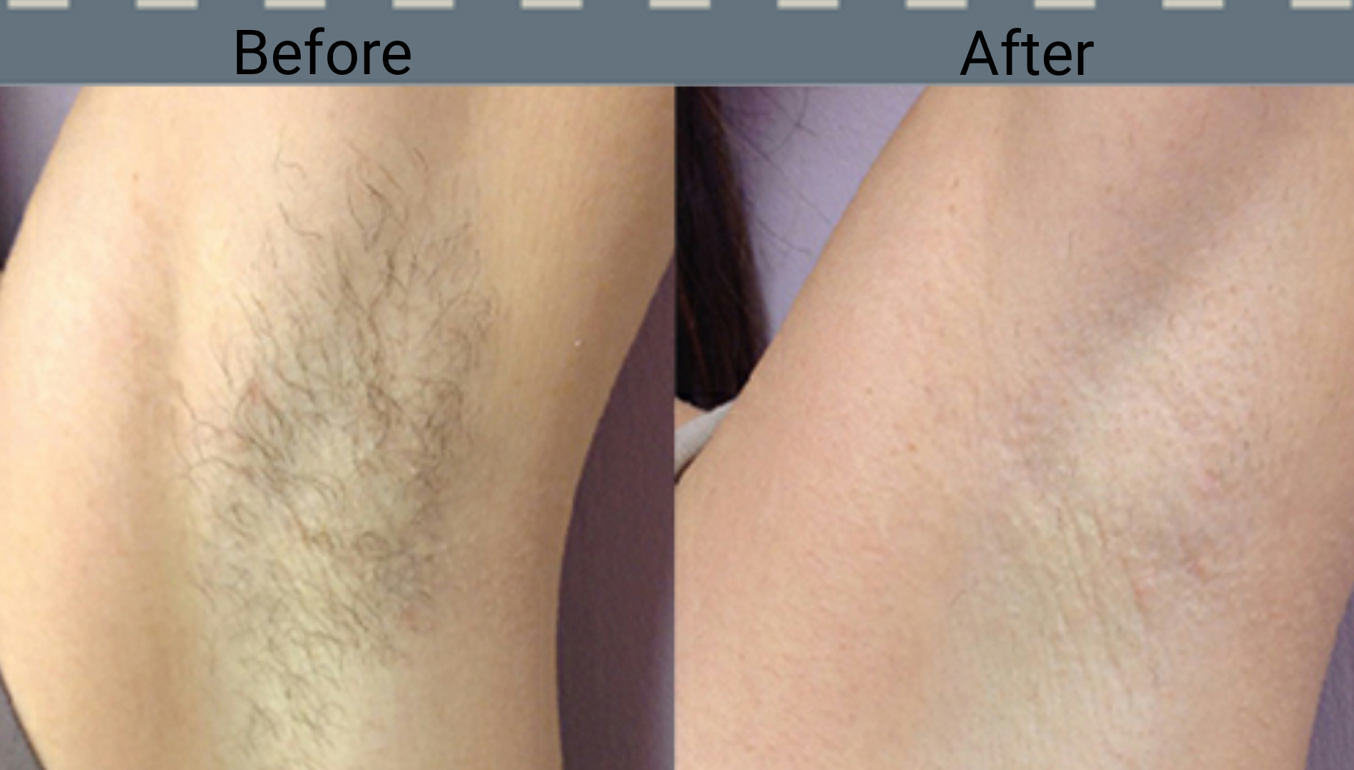 Laser hair removal can be a costly but effective way to get rid of the unwanted hair people are sick below, plastic surgeons and dermatologists detail how laser hair removal works, how much it costs how does laser hair removal work? Well Laser Hair Removal Well Aesthetic