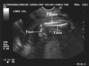 Clubfoot definition clubfoot is a condition in which one or both feet are twisted into an abnormal position at birth. Clubfoot Deformity Talipes Equinovarus