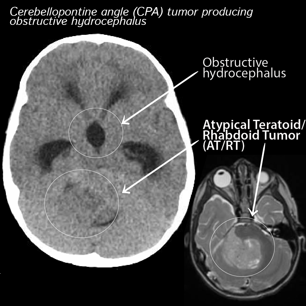 Atypical teratoid/rhabdoid tumor (atrt) is a malignant embryonal tumor of the cns that is composed of rhabdoid cells, with or without fields resembling classical primitive neuroectodermal tumor. Atypical Teratoid Rhabdoid Tumor At Rt Pathology Flashcards Draw It To Know It