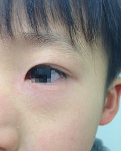 [コンプリート！] 赤ちゃん 目の下 赤いプツプツ 207694-赤ちゃん 目の下 赤いプツプツ
