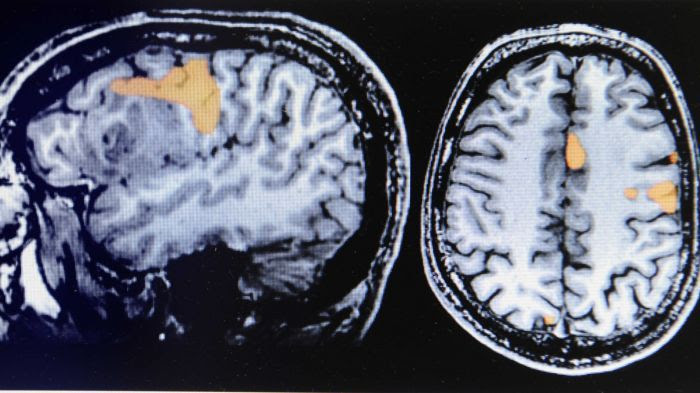 Tumeur cérébrale : un vaccin double la survie des patients