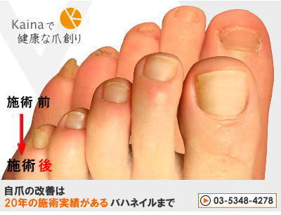 ベスト子供 爪 むしる かわいい子供たちの画像