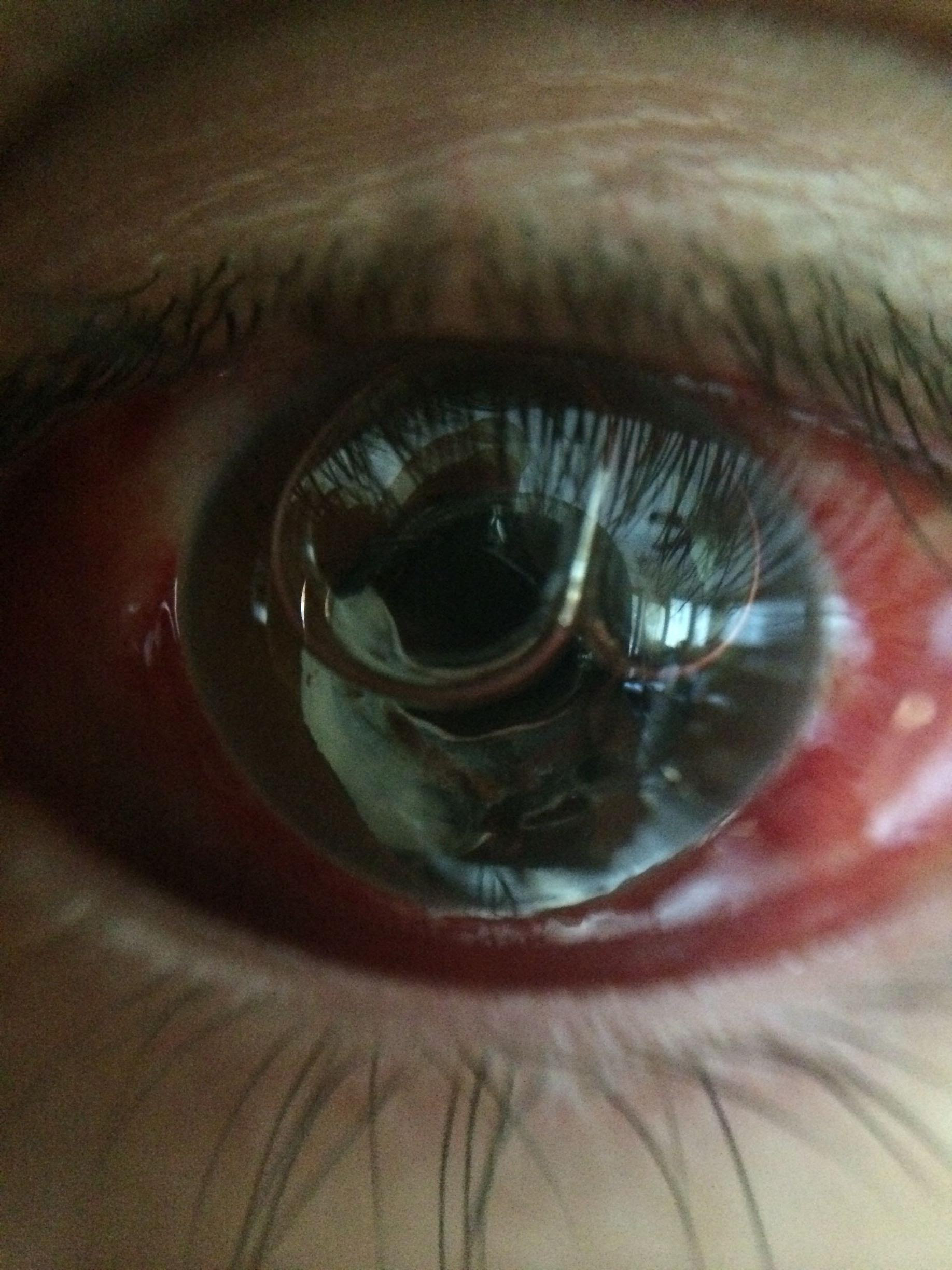 Maybe you would like to learn more about one of these? Gas Bubble In My Eye After Surgery For A Detached Retina Pics