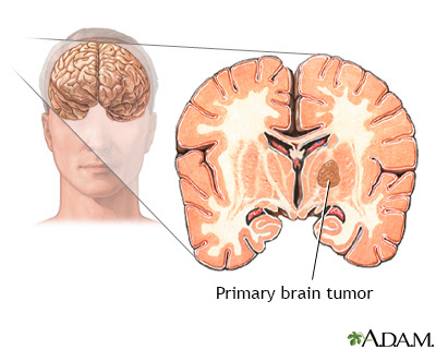Plus, not all types of tumors are made up of the same cells or are in the same location. Brain Tumor Children