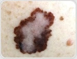 New nanovaccine for deadly skin cancer