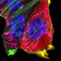 Focal Adhesions in Breast Cancer