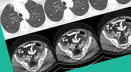 CT images of human lung and abdomen