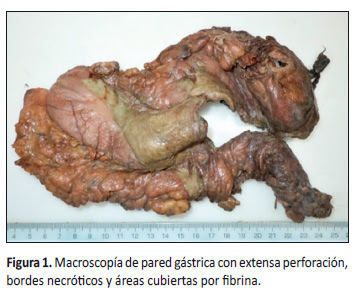 La mucormicosis es una infección por hongos saprofitos de la cavidad nasal y senos paranasales de los géneros mucor, absidia y rhizopus. Mucormicosis Diseminada En Un Paciente Diabetico Un Reporte De Caso