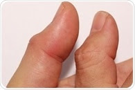 Bowler's Thumb Prevention and Treatment