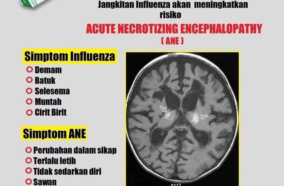 Ubat Demam Masuk Punggung Untuk Bayi - Cara Ku Mu