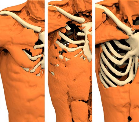 173800) is a disorder in which affected individuals are born with missing or underdeveloped muscles on one side of the body, resulting in abnormalities that can affect the chest. Poland Syndrome Terminology Anatomikmodeling