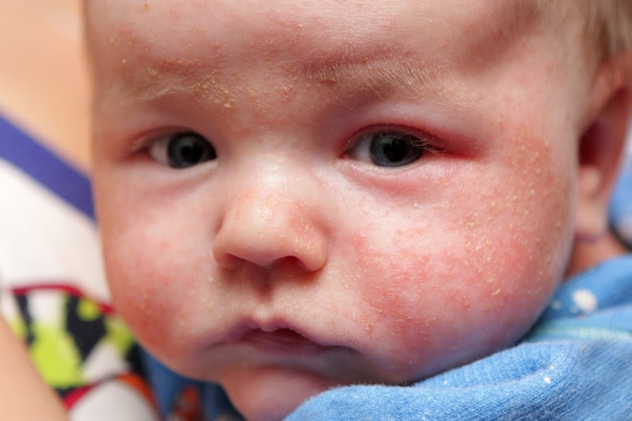 Ubat Hilangkan Ruam Muka Bayi - Contoh Gaes