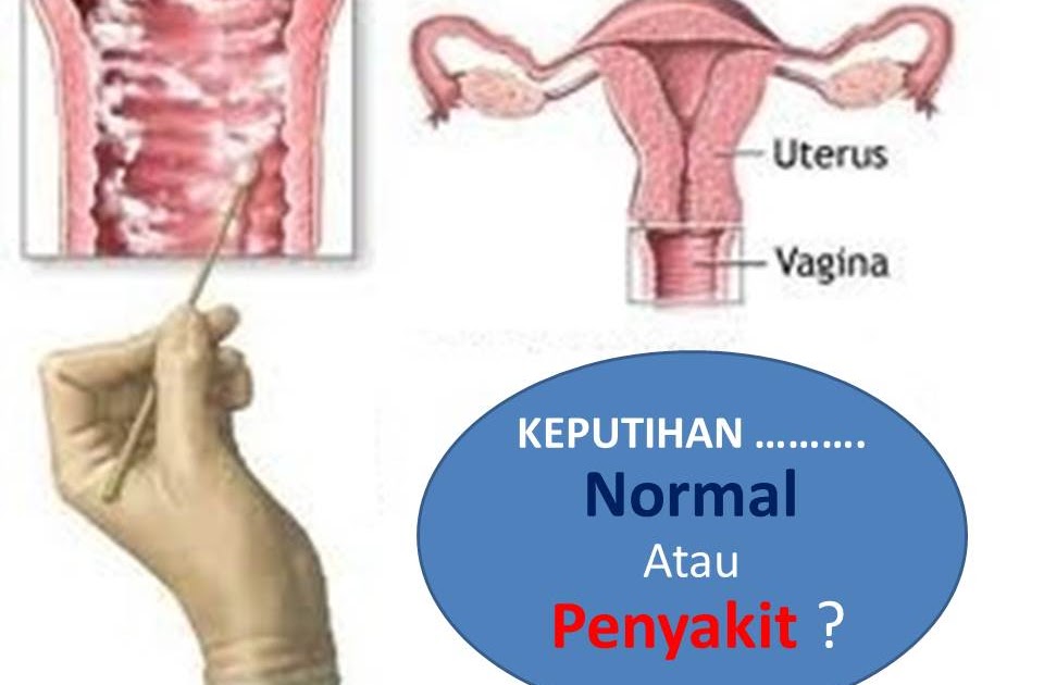 Masalah Keputihan Kronik Pulih, Keluar keputihan Berkeping 