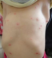 50 赤ちゃん 虫 刺され の よう な 湿疹 画像ブログ
