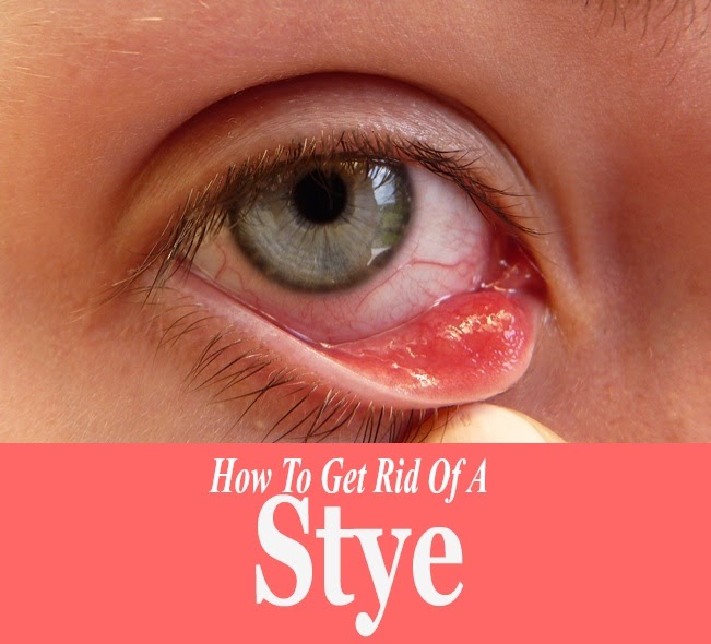 Alternative Medicines And Treatment For Stye