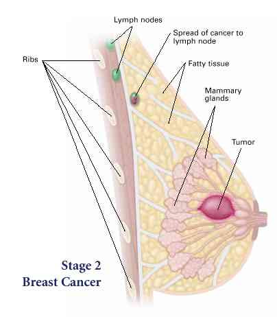 stage i is divided into subcategories known as ia and ib. All You Need To Know About Stage 2 Breast Cancer New Health Advisor