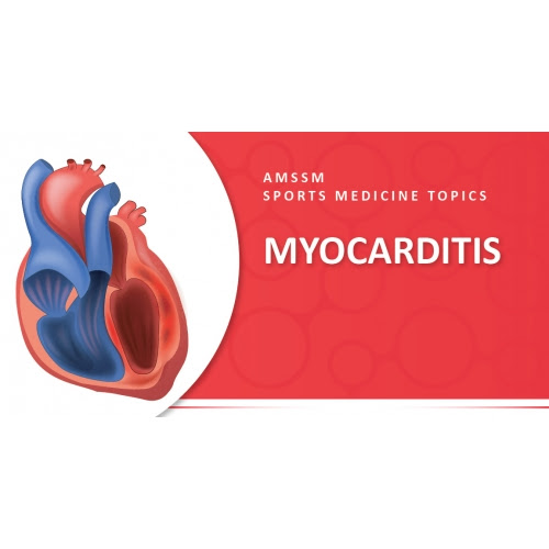 Active myocarditis in the spectrum of acute dilated. Myocarditis Sports Medicine Today