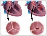 What is a Bicuspid Aortic Valve?