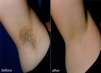 At one time, hair removal lasers although the treatment is definitely more inclusive, it still isn't for everyone. Sheer Art Beauty Diode Laser Hair Removal