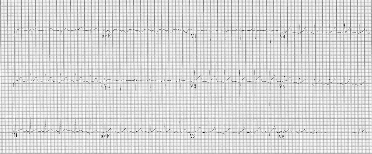 Myocarditis Ecg Changes : Covid 19 And Myocarditis What Do We Know So Far Cjc Open