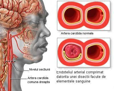 Aproximativ 85 % din avc sunt accidente vasculare cerebrale ischemice. Accidentul Vascular Cerebral Cauze Simptome Preventie Si Tratare Oficial Media