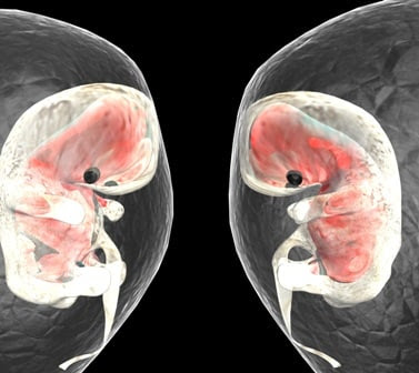 Monochorionic IVF twins pregnancies
these embryos have a higher risk of preterm.They should try to reduce their number and should give advise to the mother