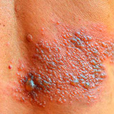 El herpes zóster aumenta el riesgo de ictus en mayores