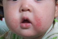 心に強く訴える子供 口の周り 湿疹 かわいい子供たちの画像