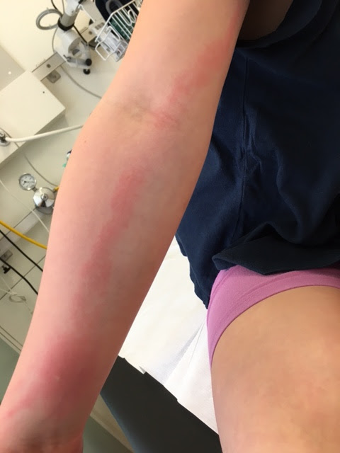 Background sepsis is the most common cause of premature death among patients with systemic lupus erythematosus (sle) aged ≤ 50 years in the united states, and infection is the most common cause of admission to the icu among sle patients. Mit Verdacht Auf Blutvergiftung Im Spital Mama On The Rocks