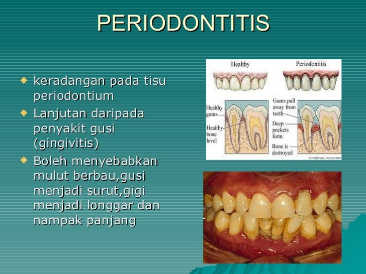 Ubat Surut Bengkak Gigi - 3 Descargar