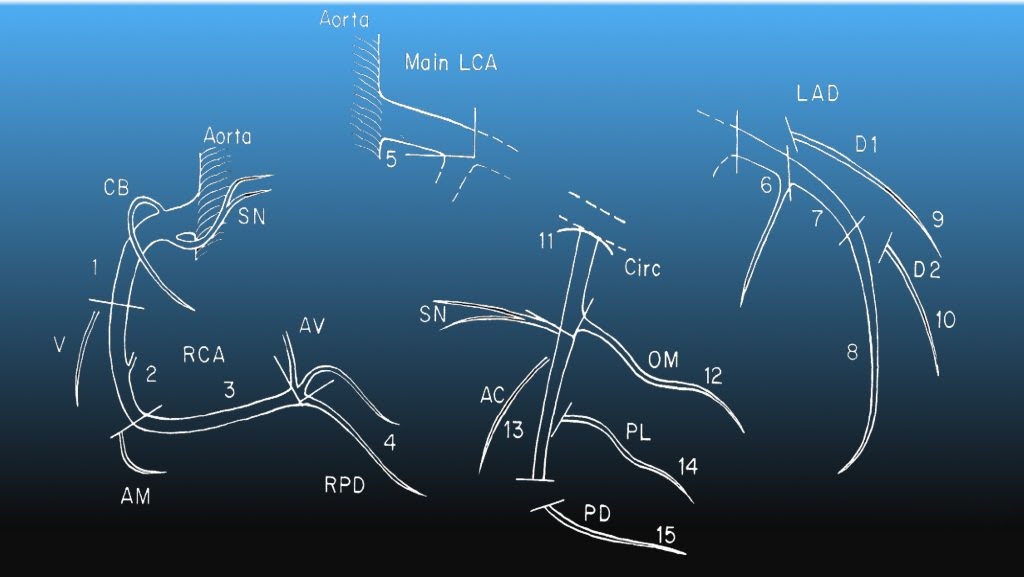 It is a diagonal artery simply because it runs diagonally the exact number of arteries in any one person are determined by genetics. Coronary Artery Segments Uw Emergency Radiology