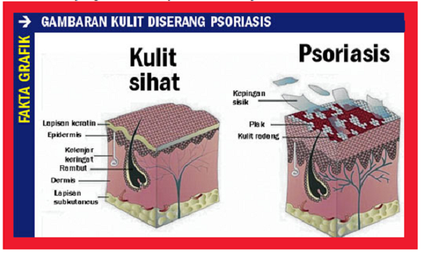 Ubat Herba Untuk Psoriasis - Hosof