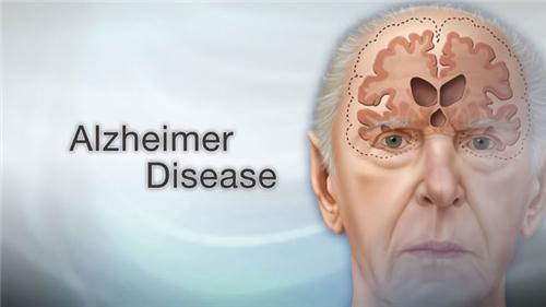 4648 4 AlzheimerHoNMinh