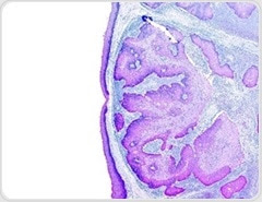 Foxp3+ Cell Density before Neoadjuvant CRT Does Not Predict Tumor Regression in Rectal Cancer