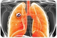 Looking outside the tumor and thinking outside the box to diagnose lung cancer