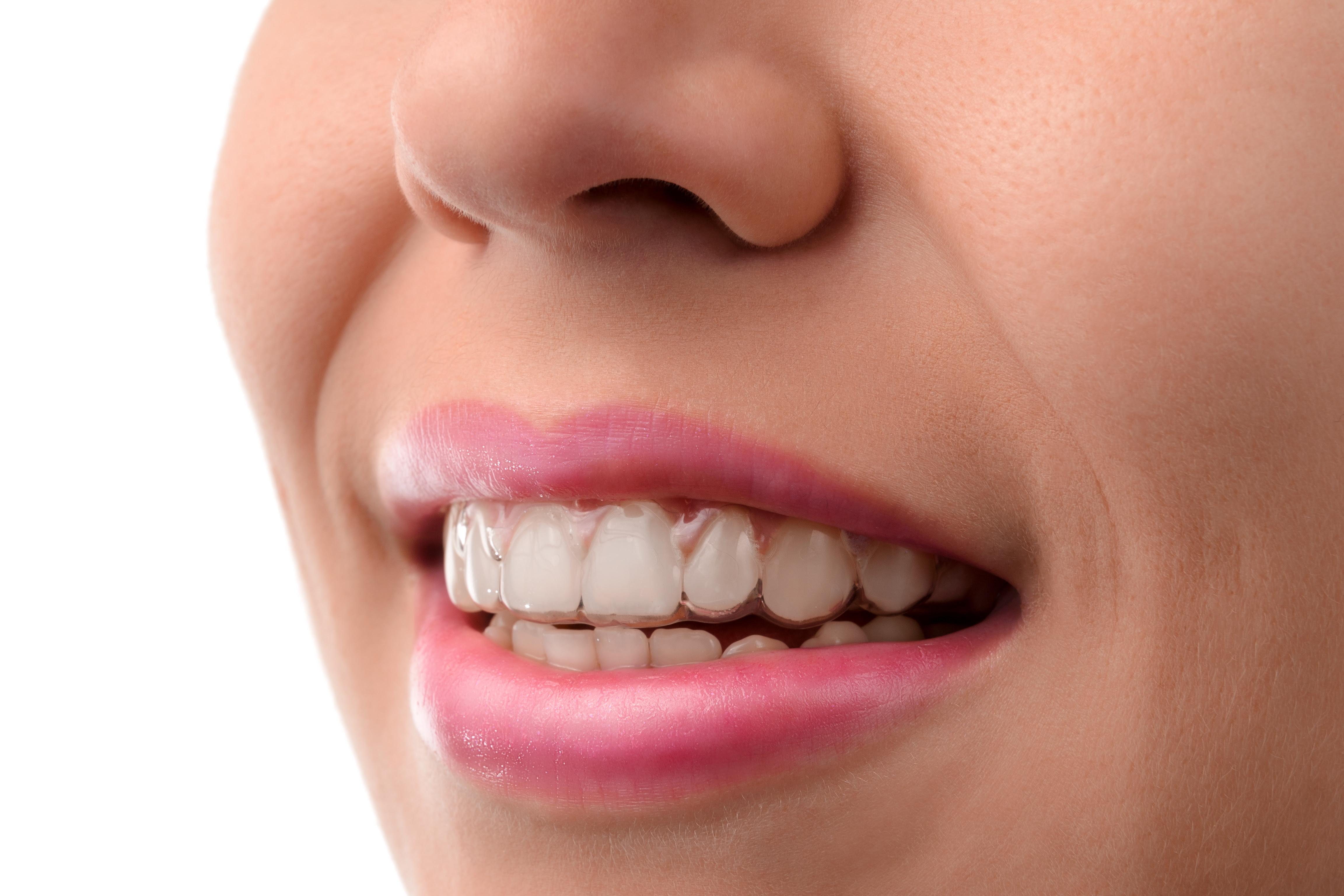 Now, invisible aligners are a common option to straighten teeth without braces. Invisalign Manchester Vs Veneers The Best Way To Straighten Teeth Blog